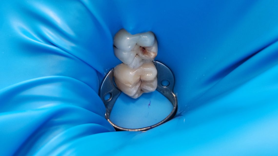 diga in stomatologie - lucrare dentara