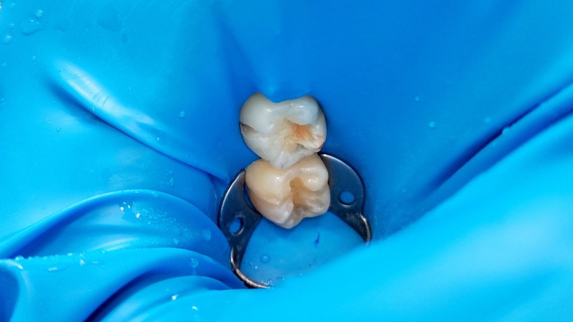 diga in stomatologie - lucrare dentara