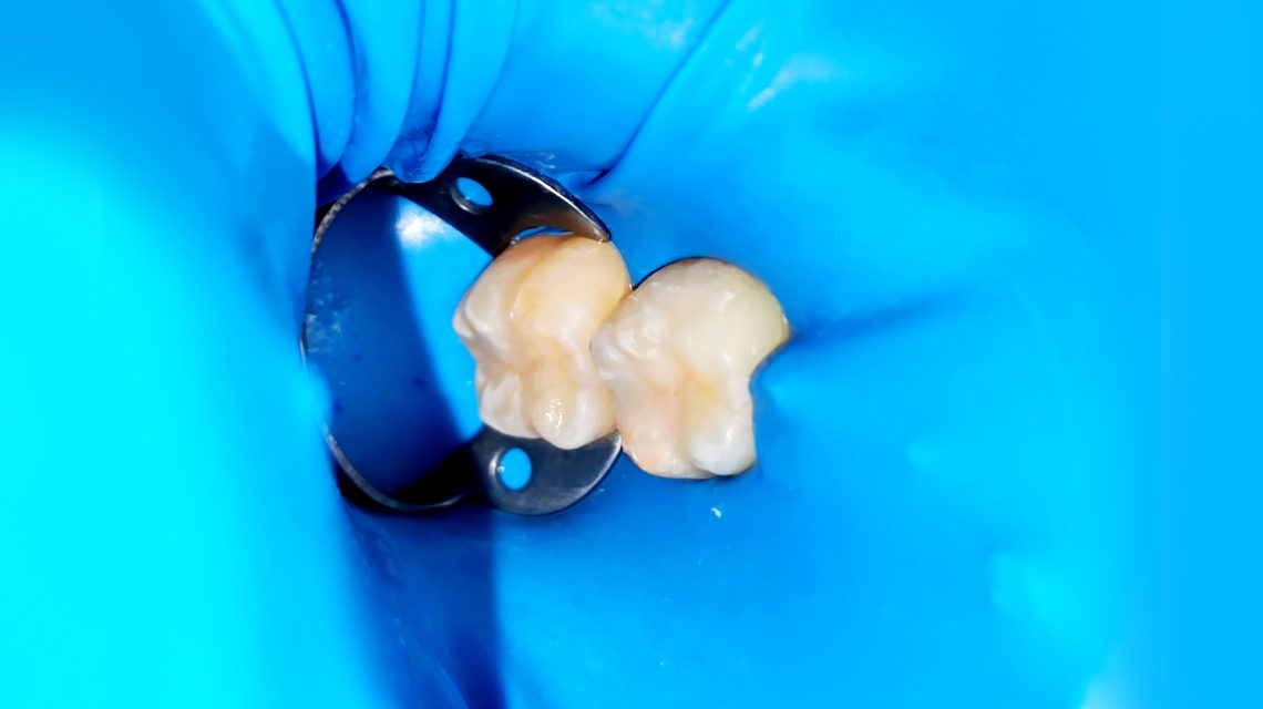 diga in stomatologie - lucrare dentara